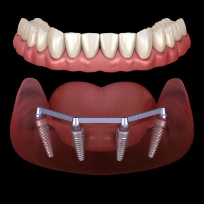 All-on-4 Dental Implants