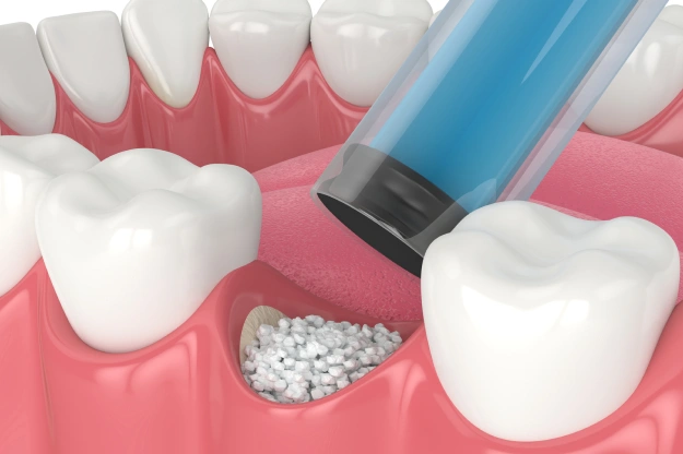 Getting Ready for Dental Implants