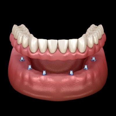 Implant Retained Dentures