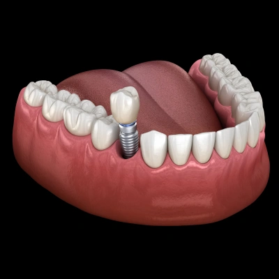 Single Dental Implant