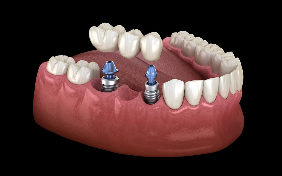 Single Tooth Implants & Bridges