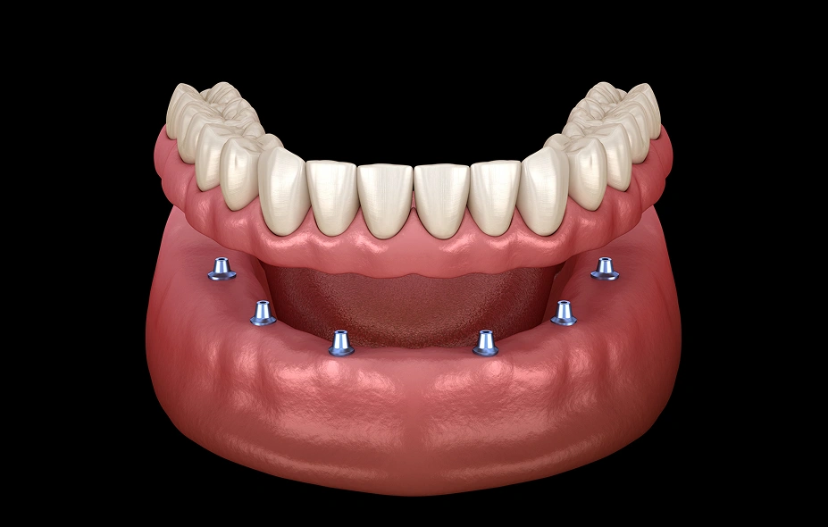 Snap-In Implant Dentures
