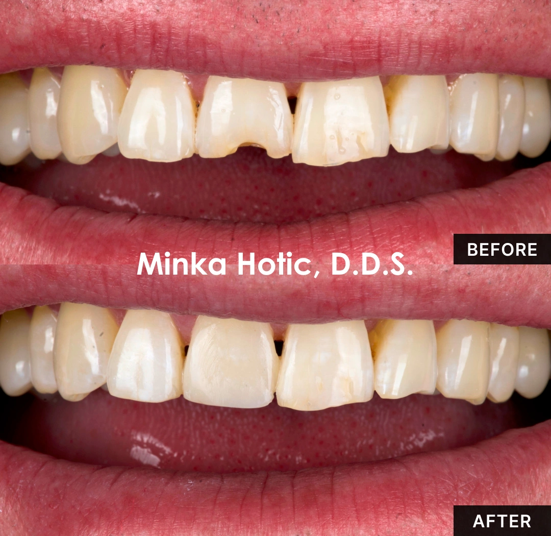 Dental Fillings