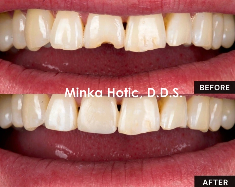 Dental Fillings